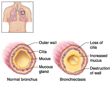 Description: Image result for bronchiectasis